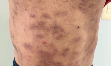 Hanseníase: Número de casos se mantém estável, mas avaliação de contatos familiares preocupa SMS de Floriano